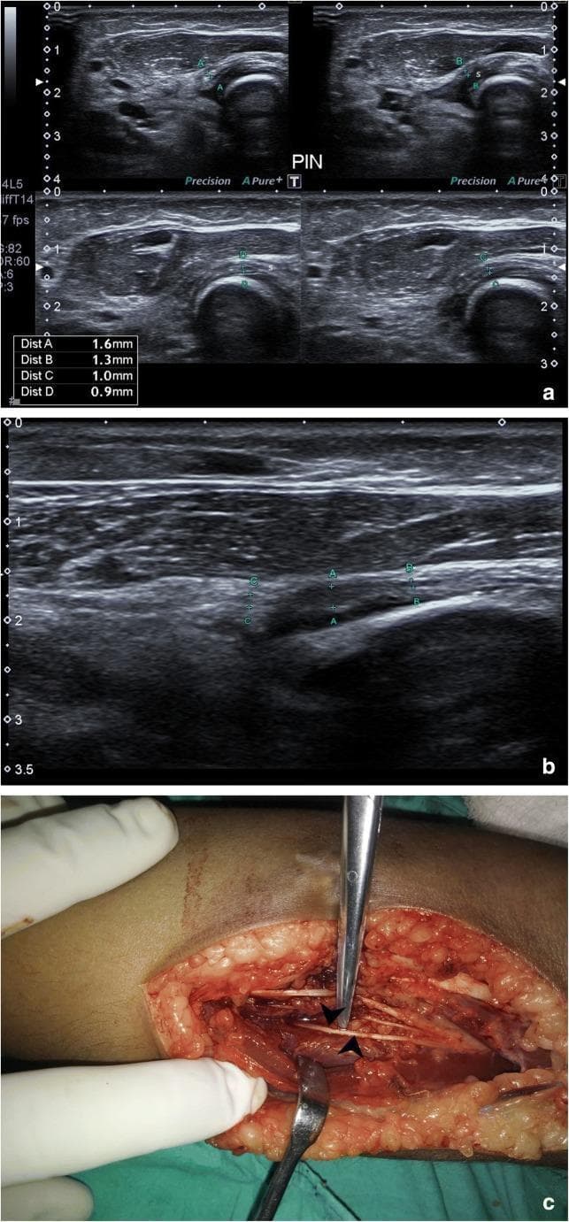 This composite educational resource illustrates the diagnostic evaluation and surgical management of posterior interosseous nerve (PIN) entrapment at the elbow. Figure (a) consists of high-resolution ultrasound frames showing the PIN in cross-section as it winds around the radial head and enters between the two heads of the supinator muscle (s). These frames demonstrate a normal nerve calibre (ranging from 0.9mm to 1.6mm) and typical speckled echogenicity. Figure (b) provides a longitudinal ultrasound view of the PIN distal to the supinator entry, showing focal thickening (calibre increase) and pathological hypo-echogenicity at point 'A', indicative of entrapment neuropathy or a pseudoneuroma. Figure (c) is a clinical photograph of the intraoperative field, showing the PIN (indicated by arrowheads) after surgical neurolysis and release from surrounding fibrous scar tissue at the radial neck. The content is suitable for orthopedic and radiology education, focusing on upper limb peripheral nerve anatomy, ultrasonography of nerve entrapment syndromes, and surgical decompression.