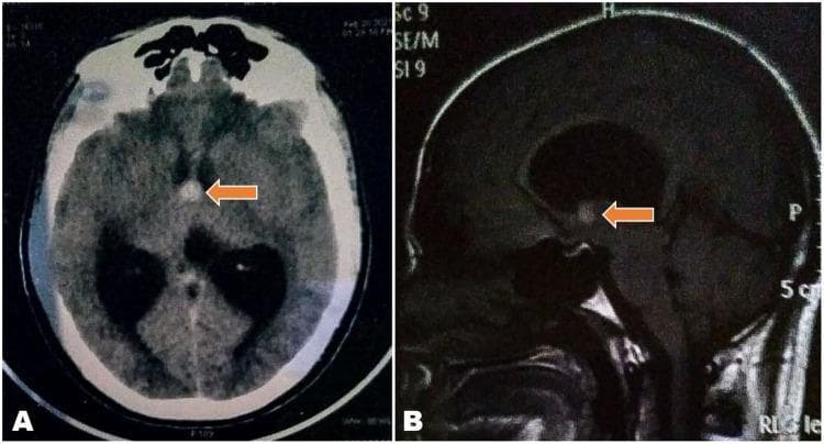 This composite diagnostic image features neuroimaging of a colloid cyst within the ventricular system. Image A is an axial non-contrast CT scan showing a well-circumscribed, hyperdense, rounded cystic lesion (indicated by an orange arrow) approximately 1 cm in diameter, located at the foramen of Monro. There is associated bilateral dilation of the lateral ventricles, consistent with obstructive hydrocephalus, without visible periventricular interstitial edema (CSF ooze). Image B is a sagittal T1-weighted MRI demonstrating a hyperintense lesion at the anterior roof of the third ventricle. The cyst causes significant effacement of the third ventricle and mechanical obstruction of the cerebrospinal fluid pathway. The combined imaging findings are characteristic of a colloid cyst of the third ventricle. This case serves as a pedagogical example of neuroanatomical landmarks, the pathophysiology of obstructive hydrocephalus, and the radiological presentation of benign intracranial masses in neurology and neurosurgery.