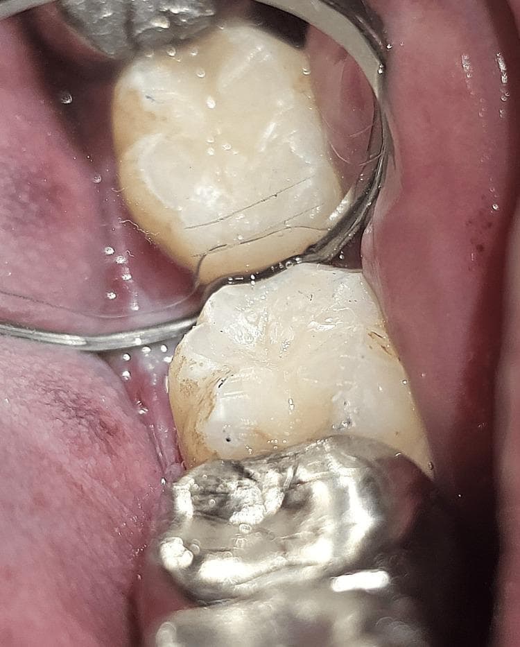 This clinical photograph provides an intraoral view of the mandibular left posterior quadrant, specifically focusing on tooth 38 (left third molar). The image demonstrates a post-operative result of a composite resin restoration on the occlusal surface. The restoration shows evidence of the 'stamp technique,' aimed at replicating the tooth's original pit and fissure morphology. Visually, the composite material appears slightly lighter than the natural enamel, with a distinct marginal interface. Small dark spots and minor surface irregularities are visible on the restored occlusal anatomy, likely representing minor stains or pits. The adjacent soft tissues, including the buccal mucosa and gingiva, appear pink with a moist, slightly granular texture. An intraoral mirror is used to reflect the occlusal table, and a metallic dental tool or portion of another restoration is partially visible in the foreground. This visual is significant for illustrating restorative dentistry outcomes and the clinical application of anatomical replication techniques for pit and fissure caries.