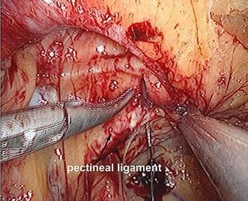 This clinical photograph provides an endoscopic surgical view of the preperitoneal space during a Totally Extraperitoneal (TEP) inguinal hernia repair. The central focus is the pectineal ligament (Cooper's ligament), which is clearly identified by a text label and arrow. The ligament appears as a white, dense fibrous band. Laparoscopic instrumentation is actively engaged in the surgical field: an atraumatic grasping forceps is seen on the left, while a surgical needle and suture material are shown puncturing the pectineal ligament. This step is part of an internal ring suturing technique designed to reduce the size of the hernia defect. The surrounding anatomy shows typical surgical features including minor hemorrhage, adipose tissue, and connective tissue layers within the inguinal region. This image serves as an educational reference for surgical landmarks and laparoscopic suturing techniques in hernia management.