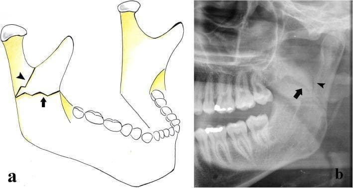 This dual-panel educational figure illustrates types of mandibular ramus fractures through an anatomical diagram and a diagnostic radiograph.
Panel A is a schematic anatomical diagram of the mandible showing two primary fracture orientations. An arrowhead indicates a vertical fracture line extending superiorly toward the sigmoid notch, while a black arrow identifies a transverse horizontal fracture line across the mid-ramus.
Panel B is a cropped panoramic radiograph (orthopantomogram) demonstrating a combined fracture of the left mandibular ramus. The radiopaque fracture line originates from the posterior/external border of the ramus. Similar to the diagram, it exhibits a complex morphology with both a vertical component (arrowhead) extending toward the condylar process and a horizontal component (arrow) extending anteriorly toward the coronoid process. The imaging displays a clear disruption in cortical continuity.
These visuals serve to teach the classification of ramus fractures, which are typically caused by direct high-energy trauma and categorized based on the direction of the fracture rhyme (vertical, horizontal, or combined).