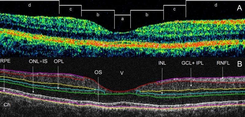 Diagnostic optical coherence tomography (OCT) scans of a healthy human macula, demonstrating retinal layer segmentation using the OCTRIMA program. Panel A displays a cross-sectional B-scan with color-coded reflectance intensities, categorized into four topographical regions: foveolar (a), foveal (b), parafoveal (c), and perifoveal (d). Panel B illustrates the segmented intraretinal boundaries based on optical density. The identified layers include the retinal nerve fiber layer (RNFL), the ganglion cell and inner plexiform layer complex (GCL+IPL), inner nuclear layer (INL), outer plexiform layer (OPL), outer nuclear layer and inner segment of photoreceptors (ONL+IS), outer segment (OS), and retinal pigment epithelium (RPE). The scan highlights normal anatomical features, such as the foveal depression where inner retinal layers thin centrally, leaving predominantly outer layers. Below the hyperreflective RPE/OS complex, the heterogeneous choroid (Ch) is visible, with the hyporeflective vitreous (V) located above the internal limiting membrane. This visual serves as an educational reference for normal retinal architecture and automated software segmentation in ophthalmology.