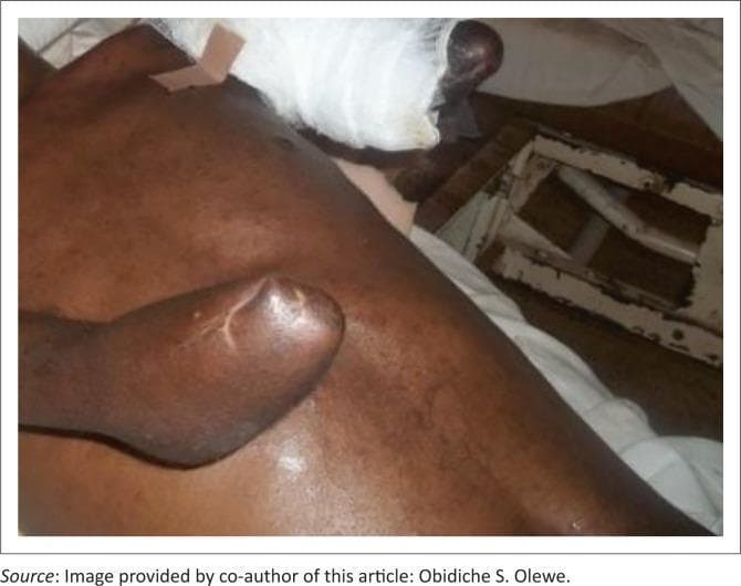 This clinical photograph shows a male patient three months post-operatively following bilateral upper limb amputations, a common sequela of severe high-voltage electrical injuries. On the patient's left side, there is an above-elbow (transhumeral) amputation; the residual limb appears well-healed with a rounded distal contour and no visible signs of acute inflammation or infection. On the patient's right side, a below-elbow (transradial) amputation is visible, currently managed with a white gauze dressing and medical tape extending toward the shoulder, suggesting ongoing wound care or protection of the surgical site. The patient is in a supine position, and the surrounding torso skin shows signs of prior trauma or healing. This image serves as a clinical example of post-amputation recovery and surgical management in the context of major limb trauma and burn rehabilitation within the specialties of orthopedic and plastic surgery.