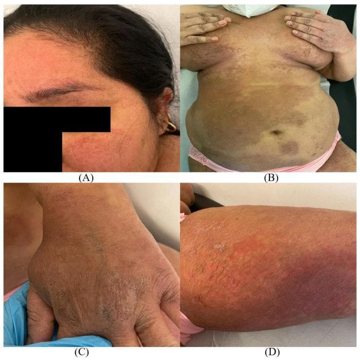 This composite clinical photograph displays widespread dermatophytosis (tinea) across four anatomical regions: the face (A), trunk (B), hand (C), and groin/thigh (D). The lesions are characterized by large, erythematous, scaly plaques with distinctive sharp, slightly raised borders. Image A (tinea faciei) shows confluent red patches on the forehead and cheeks. Image B (tinea corporis) demonstrates extensive, multi-colored annular plaques covering the abdomen and submammary regions. Image C (tinea manuum) illustrates diffuse hyperkeratosis and scaling on the dorsal hand. Image D (tinea cruris) reveals a prominent, intensely erythematous plaque with active scaling at the margins on the inner thigh. These clinical features represent a severe and extensive presentation of superficial fungal infection, typical of multidrug-resistant dermatophyte strains like Trichophyton indotineae. The distribution pattern highlights the progressive nature of the infection from localized to disseminated cutaneous involvement.