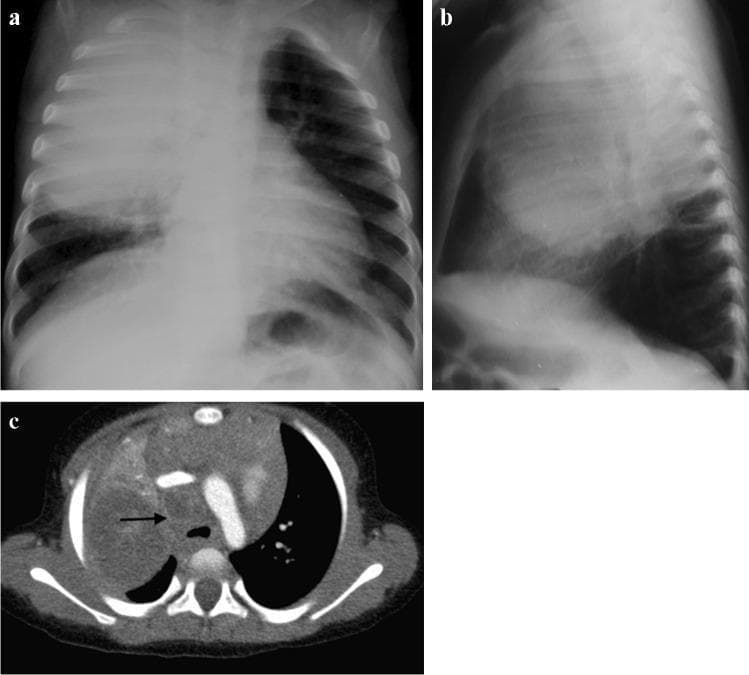 This composite figure displays multi-modality chest imaging of a 2-year-old pediatric patient with primary pulmonary tuberculosis. (a) Posteroanterior chest radiograph (CXR) demonstrates significant opacification in the right upper lobe consistent with lobar pneumonia. Notable secondary findings include leftward tracheal deviation and narrowing of the bronchus intermedius, suggesting compressive paratracheal lymphadenopathy. (b) Lateral CXR confirms the right upper lobe involvement, showing an inferiorly bulging horizontal fissure and soft tissue density in the subcarinal region representing hilar/mediastinal lymphadenopathy. (c) Axial post-contrast CT (mediastinal window) reveals high-volume, low-density mediastinal lymphadenopathy with characteristic peripheral rim enhancement (arrow), indicating caseous necrosis within the nodes. The right upper lobe appears expanded with predominantly low attenuation, further suggestive of caseous pneumonia. A small, associated right-sided pleural effusion is also visualized. The imaging collectively illustrates the classic triad of pediatric primary tuberculosis: parenchymal consolidation, significant lymphadenopathy, and evidence of necrotic tissue (caseation).