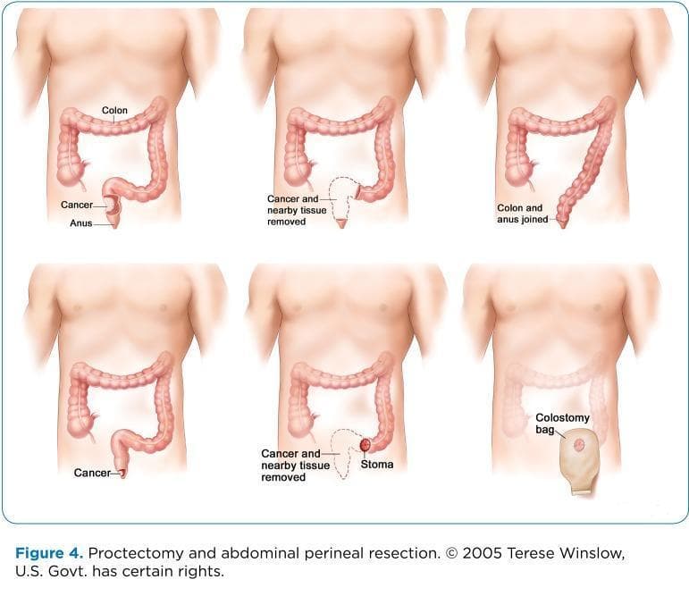 This medical illustration depicts surgical procedures for rectal cancer: proctectomy and abdominoperineal resection (APR). The diagram is organized into two primary sequences shown on a male anatomical torso. The top row illustrates a proctectomy with colorectal anastomosis: starting with the identification of a rectal tumor, followed by the resection of the cancer and adjacent tissues, and concluding with the primary joining (anastomosis) of the descending colon to the remaining anal canal. The bottom row illustrates an abdominoperineal resection (APR) leading to a permanent colostomy: it begins with the identified rectal cancer, shows the removal of the rectum, anus, and surrounding tissues, the creation of an abdominal stoma from the distal end of the colon, and the final application of an external colostomy bag for waste collection. Key anatomical labels include the colon, anus, cancer site, stoma, and colostomy bag. This educational visual is designed to explain colorectal surgical oncology options and postoperative anatomical changes.