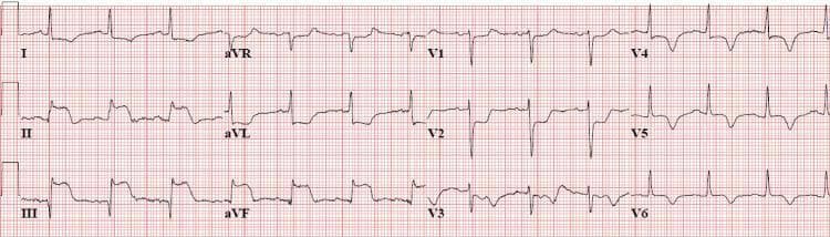 A standard 12-lead electrocardiogram (ECG) demonstrating an acute inferior ST-segment elevation myocardial infarction (STEMI). The tracing reveals significant ST-segment elevation in the inferior leads (II, III, and aVF), characterized by concave or 'tombstoning' morphology and associated with prominent, hyperacute T-waves. Reciprocal ST-segment depression is clearly visible in the high lateral lead (aVL) and the precordial leads (V1, V2, and V3). The precordial leads also show deep S-waves and evolving R-wave transitions. The heart rhythm indicates a regular sinus tachycardia. This ECG is a critical diagnostic tool in emergency medicine and cardiology for identifying transmural ischemia in the distribution of the right coronary artery (RCA) or left circumflex artery, requiring immediate clinical correlation and reperfusion therapy.