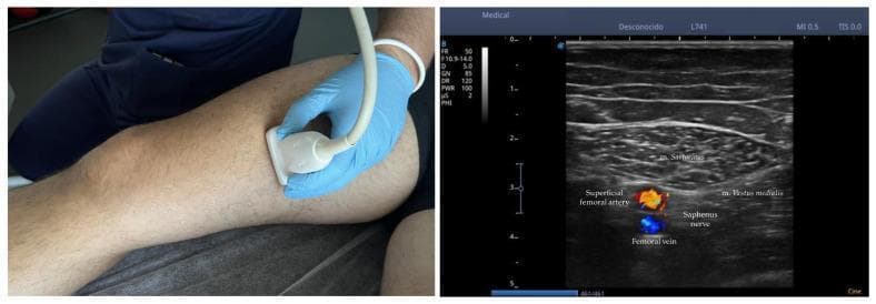 This composite educational material consists of a clinical photograph and a corresponding B-mode ultrasound with color Doppler. The clinical photograph on the left shows the positioning of a multifrequency linear array transducer on the medial aspect of the thigh, approximately 10-15 cm above the knee joint. The ultrasound image on the right demonstrates the anatomical cross-section for saphenous nerve identification within the subsartorial (adductor) canal. Key muscular landmarks labeled include the m. sartorius in the superficial plane and the m. vastus medialis on the medial side. Vascular structures are highlighted with color Doppler, identifying the superficial femoral artery (red) and the femoral vein (blue). The saphenous nerve is visualized in the intermuscular fat pad at this anatomical crossroads. This visual is designed for advanced clinical practice, specifically for ultrasound-guided nerve identification, regional anesthesia, or percutaneous electrical nerve stimulation (PENS). It illustrates the necessary anatomical relationships for distinguishing the saphenous nerve and its infrapatellar branch before distal division.
