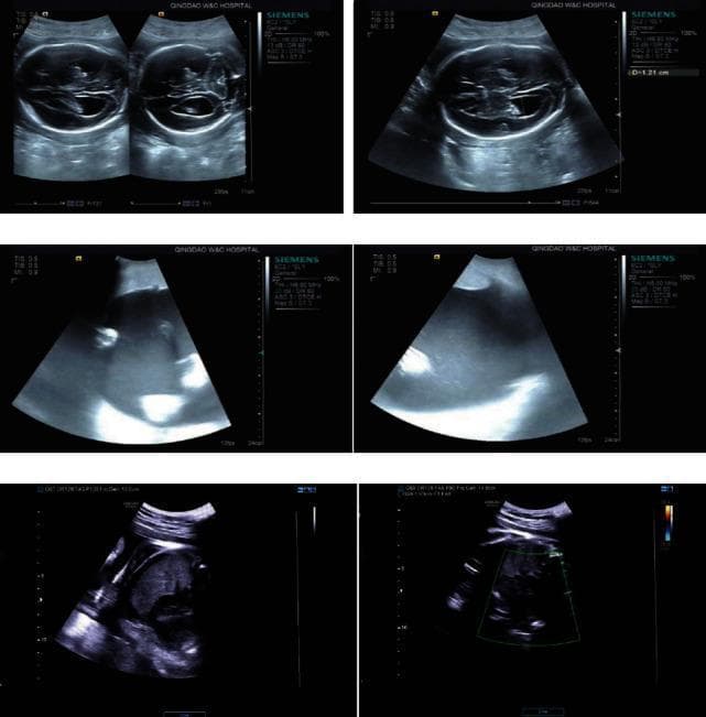 This composite image consists of six B-mode obstetric ultrasound frames arranged in a 3x2 grid, monitoring fetal health in patients with pregestational diabetes mellitus (PGDM) and gestational diabetes mellitus (GDM). The top row features transverse axial views of the fetal head, demonstrating the calvarium, midline falx, and intracranial structures such as the choroid plexus within the lateral ventricles. These views are typically used to measure the biparietal diameter (BPD) and head circumference (HC). The middle and bottom rows display sagittal and cross-sectional views of the fetal trunk, including the abdomen and thorax. Visible features include the echogenic spinal column, the hypoechoic region of the fetal stomach, and the umbilical cord insertion site. The rightmost bottom frame includes a color Doppler overlay box for assessing blood flow. The images illustrate routine morphological and biostatistical assessment in the second and third trimesters to evaluate fetal growth and potential macrosomia or anomalies associated with diabetic pregnancies.