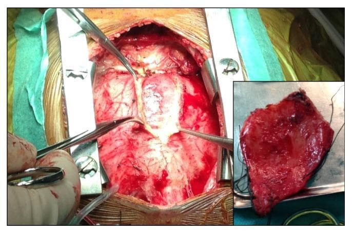 This clinical photograph captures an intraoperative view of a pericardiectomy procedure in a patient with chronic fibrous constrictive pericarditis. The primary image displays a median sternotomy with the heart exposed; the visceral and parietal layers of the pericardium appear significantly thickened, opaque, and whitish-tan in color, demonstrating loss of normal translucency. Surgical retractors and forceps are positioned to elevate the adherent, fibrous tissue from the epicardial surface. An inset image shows a gross pathological specimen of the excised pericardium. The specimen is predominantly reddish due to hypervascularization and surgical hemorrhage, featuring an irregular, roughened texture and marked thickening. The visual findings illustrate the physiological basis for ventricular constriction, where a rigid, non-compliant pericardial sac restricts cardiac filling. This content is representative of advanced cardiothoracic surgical pathology often associated with chronic inflammatory conditions such as tuberculosis.