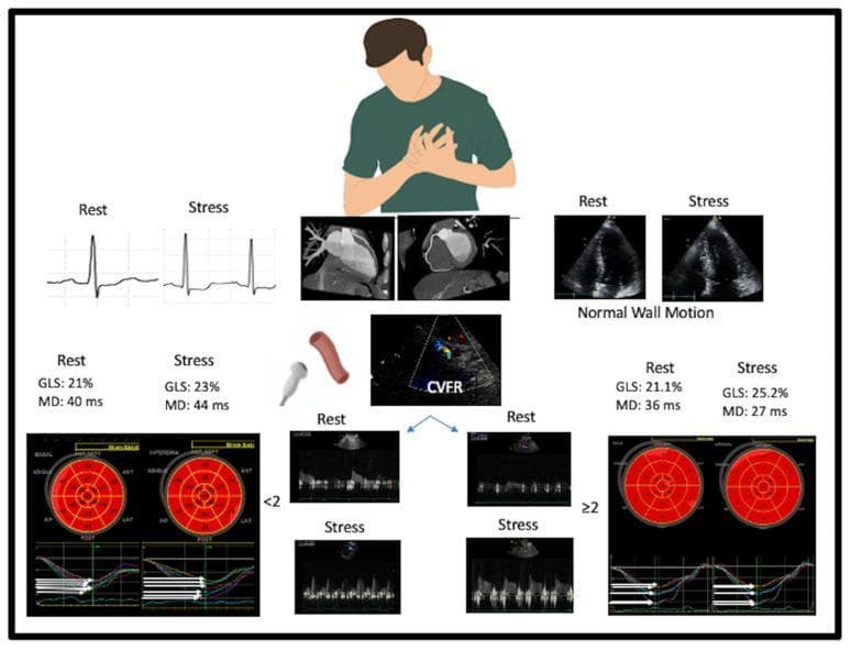This medical illustration and clinical diagnostic panel outlines the assessment of coronary microvascular angina. The top section depicts a clinical presentation of chest pain alongside initial tests: ECG strips comparing 'Rest' and 'Stress' (showing ST-segment depression under stress), Multidetector Computed Tomography (MDCT) images of normal coronary arteries, and 2D stress echocardiography (SE) views demonstrating normal wall motion. The lower section details a functional assessment algorithm focused on Coronary Flow Velocity Reserve (CVFR). A color Doppler image transitions into two clinical pathways based on CVFR values. The left pathway (CVFR < 2) signifies a positive microvascular response, supported by Doppler velocity waveforms, strain bullseye plots, and time-based strain curves showing reduced Global Longitudinal Strain (GLS) and increased Mechanical Dispersion (MD) during stress. The right pathway (CVFR ≥ 2) indicates a negative response for microvascular dysfunction, characterized by augmented stress Doppler waveforms, improved GLS (25.2%), and reduced MD (27 ms). The diagram serves as an educational resource for differentiating coronary microvascular dysfunction from obstructive coronary disease using advanced echocardiographic strain and flow reserve parameters.