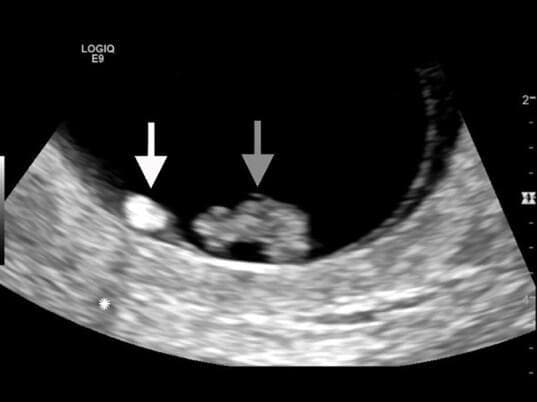 This diagnostic image is a close-up transvaginal sonogram of an intrauterine pregnancy. The grayscale ultrasound displays a gestational sac containing key embryonic structures. A fetal pole, indicated by a gray arrow, appears as an irregular mass with mixed echogenicity. Adjacent to it, a small, well-defined, and highly echogenic circular structure (white arrow) represents the yolk sac. Notable posterior acoustic shadowing, marked by an asterisk, is visible as a hypoechoic region distal to the fetal pole. This educational visual demonstrates the spatial relationship and echogenicity characteristics of early pregnancy structures, often used in obstetrics and emergency medicine to evaluate symptoms such as lower abdominal cramping and vaginal spotting. The image serves as a reference for point-of-care pelvic ultrasound interpretation, highlighting normal and abnormal sonographic markers during the first trimester.