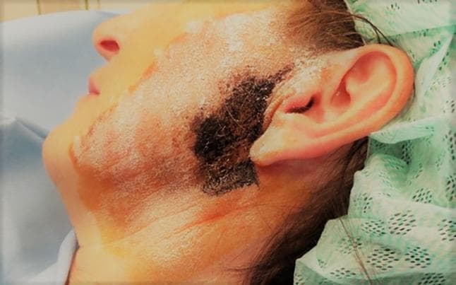 This clinical photograph displays a patient's left profile, focusing on the preauricular and parotid region during a Minor starch-iodine test. The skin is coated with a white, powdery layer of starch. A prominent, irregularly shaped black-to-dark-blue patch is visible anterior to the tragus of the ear and extending onto the cheek, representing a positive result where gustatory sweating has occurred. This chemical reaction occurs when moisture triggers iodine to form a dark complex with the amylose in starch, mapping the territory of Frey's syndrome (auriculotemporal syndrome). Faint reddish and brownish vertical lines on the lower cheek and neck indicate the application of iodine solution or anatomical markings for subsequent treatment. The image illustrates the diagnostic localization of aberrant gustatory sweating prior to therapeutic interventions like botulinum toxin-A injections. Target audience includes medical students and practitioners in neurology, ENT, or maxillofacial surgery.