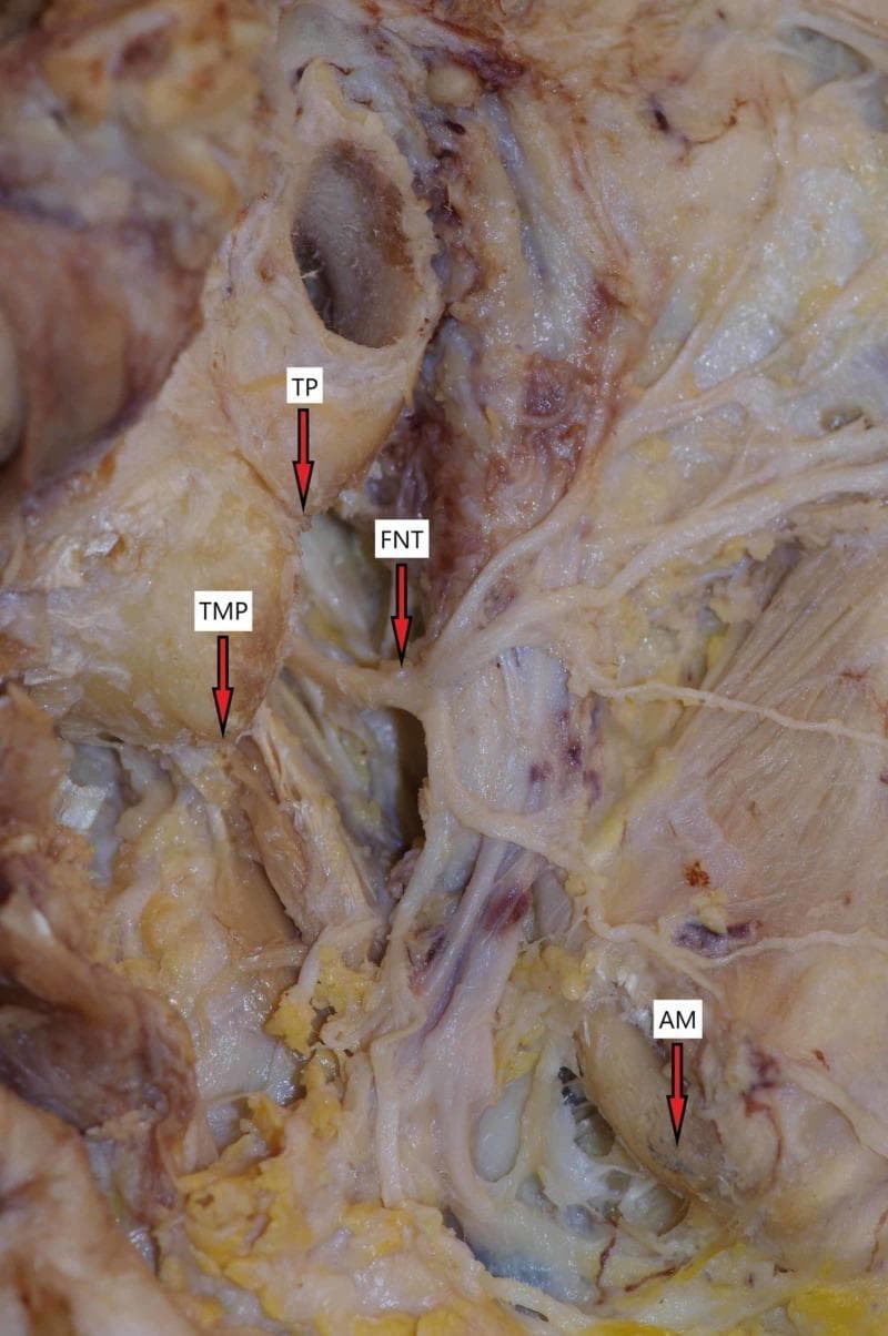 A clinical photograph of a deep cadaveric dissection of the parotid and retromandibular region, demonstrating the surgical anatomy of the facial nerve (cranial nerve VII). The image features several key anatomical landmarks used to identify the nerve during surgery. The facial nerve trunk (FNT) is shown emerging from the stylomastoid foramen, positioned inferior and medial to the tragal pointer (TP). The tip of the mastoid process (TMP) is identified lateral and slightly superior to the nerve trunk. Inferiorly, the angle of the mandible (AM) is labeled, serving as a distal reference point. The dissection reveals the initial branching pattern of the nerve as it enters the parotid gland space. This anatomical diagram is intended for surgical planning and medical education in the fields of otorhinolaryngology and maxillofacial surgery, specifically for procedures such as parotidectomies where nerve preservation is critical.