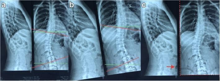 This diagnostic image consists of three panels (a, b, and c) showing anteroposterior (AP) spinal X-ray radiographs used to demonstrate Cobb angle measurement techniques for scoliosis. The images depict the thoracolumbar spine with a visible lateral curvature. Panel 'a' shows a normally oriented film with superimposed horizontal green reference lines and red lines marking the vertebral endplates to calculate the tilt angle. Panel 'b' illustrates a tilted film simulation, demonstrating that the endplate tilt angle relative to the film's horizontal plane remains consistent even when the image is misaligned on a viewing surface. Panel 'c' highlights reference markers used to minimize measurement error, including a red dotted line outlining the rectangular boundary of the imaging data and a red arrow pointing to a vertical ruler line. These markers establish a true horizontal plane for accurate angular assessment. The visual material is designed for orthopedic and radiological education, specifically focusing on the geometry of spinal deformity measurement and the mitigation of extrinsic errors in clinical practice.