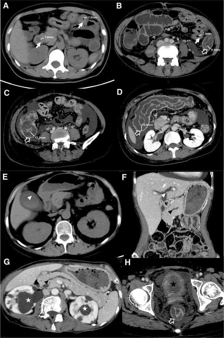 This composite of eight CT images (A–H) illustrates a clinical scoring system for gastrointestinal (GI) and extra-GI involvement in Systemic Lupus Erythematosus (SLE). Images A–D and H demonstrate abnormal bowel wall thickening across various segments: the duodenum and jejunum (A, 7.3–7.6 mm), ileum and descending colon (B, 7.3–9.4 mm), ileocecum (C, 12.2 mm), transverse colon (D, 15.4 mm), and rectum (H). White arrows indicate the small intestine, while hollow arrows denote the large intestine. Extra-GI manifestations are also highlighted: Image E shows gallbladder wall thickening (white arrowhead), and F shows biliary duct dilatation (white arrowhead) alongside pancreatic duct dilatation (black arrowhead in F and G). Urinary system involvement is evidenced by ureterohydronephrosis (white asterisks in D and G) and bladder wall thickening (black asterisk in H). These findings collectively facilitate a CT-based assessment of intestinal pseudo-obstruction (VPO) severity and the presence of multi-organ inflammation characteristic of vasculitic complications in lupus patients.