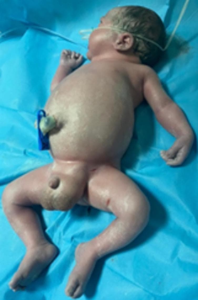 Clinical photograph of a newborn in the immediate postnatal period demonstrating hydrops fetalis with severe anasarca. The infant exhibits generalized, massive soft tissue edema. Key visual features include a markedly distended abdomen consistent with significant ascites, and severe swelling of the upper and lower extremities resulting in the loss of normal skin folds and obscured anatomical landmarks. The skin appears taut and shiny due to subcutaneous fluid accumulation. Pronounced scrotal edema is also visible. The infant is placed on a blue sterile field with a clamped umbilical cord and an orogastric tube in situ. This presentation is clinically significant for systemic fetal fluid overload, often secondary to cardiac failure (such as from a rhabdomyoma), severe anemia, or immune/non-immune hydrops. The image serves as a teaching example of the phenotypic manifestations of neonatal anasarca and its association with Mirror syndrome in the mother.
