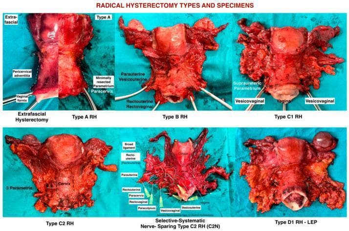 A comparison of surgical specimens from different types of radical hysterectomy (RH), demonstrating the varying extent of tissue resection according to the Querleu-Morrow classification. The image includes six panels: Extrafascial Hysterectomy, Type A RH, Type B RH, Type C1 RH, Type C2 RH, Selective-Systematic Nerve-Sparing Type C2 RH (C2N), and Type D1 RH-LEP. Key anatomical structures and landmarks are labeled, including the pericervical adventitia, parauterine and paracervical tissues, rectouterine/rectovaginal ligaments, vesicouterine/vesicovaginal ligaments, and paracolpium. The specimens illustrate the progression of surgical radicality: Type A shows minimal parametrial resection; Type B shows resection at the ureteric level; Type C1 focuses on supraureteric parametria; Type C2 shows total resection of supraureteric and infraureteric parametria to the pelvic floor; C2N highlights nerve-sparing techniques preserving autonomic pathways; and Type D1 represents laterally extended parametrectomy involving the internal iliac vascular system at the pelvic sidewall. This visual resource is used to teach surgical-anatomical margins and oncological resection principles in gynecologic oncology.
