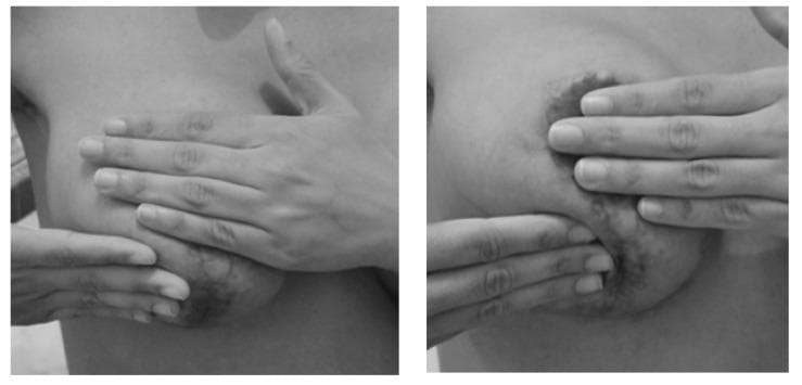 Two grayscale clinical photographs demonstrate manual therapy techniques for postoperative breast scar tissue management. In the left panel, a broad-handed compressive technique is shown, with the therapist's hand placed flat against the upper aspect of the breast and the second hand supporting the lower pole. The right panel displays a more localized manual mobilization focused on a visible, hyperpigmented, and uneven scar area near the areola. The fingertips are used to apply targeted pressure and stretching to the thickened tissue. These images illustrate physical therapy interventions following breast cancer surgery aimed at improving tissue elasticity, preventing adhesions, and normalizing the texture of hardened areas. The clinical focus is on early postoperative rehabilitation and functional recovery of the breast and chest wall.