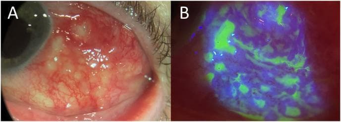 Educational slit-lamp clinical photographs showing infectious scleritis or conjunctivitis in the temporal region of the left eye. Image A (white light) demonstrates significant conjunctival and scleral injection (hyperemia) with engorged blood vessels. Centered in the inflamed area are multiple, yellowish-white multiloculated abscesses associated with active purulent drainage, indicating a localized infectious process. Image B (cobalt blue light with fluorescein staining) of the same ocular region highlights extensive epithelial disruption. The bright green fluorescence reveals multiple small, irregular conjunctival erosions and larger areas of epithelial loss corresponding to the sites of inflammation and abscess formation. These images serve as a diagnostic reference for identifying severe ocular surface infections and assessing tissue integrity through fluorescein staining.