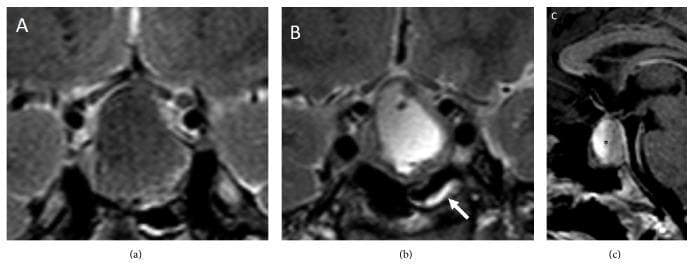 This set of diagnostic MRI scans illustrates the neuroradiological hallmarks of pituitary apoplexy across three views. Panels (a) and (b) are coronal T2-weighted images demonstrating a heterogeneous sellar and suprasellar mass. Panel (a) shows areas of low signal intensity corresponding to intralesional hemorrhage, while panel (b) reveals high-signal intensity cystic or necrotic regions and focal mucosal thickening of the sphenoid sinus (indicated by the white arrow), a secondary finding in acute apoplexy. Panel (c) provides a sagittal T1-weighted view showing a fluid-fluid level (marked by an asterisk) within the pituitary mass. This specific finding is pathognomonic for pituitary apoplexy, representing the layering of settled cellular blood components inferiorly and free extracellular methemoglobin superiorly. The images collectively demonstrate the typical mass effect of a pituitary adenoma complicated by acute infarction or hemorrhage, essential for medical students and clinicians to recognize in cases of acute pituitary failure or visual compromise.