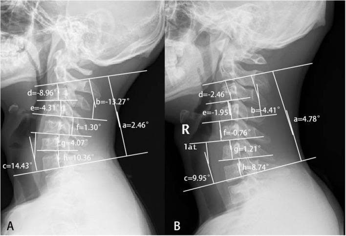 This diagnostic image displays two conventional sagittal cervical radiographs, labeled A and B, demonstrating different cervical spine curvatures in Hirayama disease. Radiograph A illustrates a 'reverse S-shape' pattern, characterized by upper cervical kyphosis (negative Cobb angles from C2-C4) and lower cervical lordosis (positive Cobb angles from C5-C7). The C2-4 Cobb angle (b) is -13.27°, while the C5-7 angle (c) is 14.43°. Radiograph B shows a relatively straight cervical spine typical of simple distal Hirayama disease, with a global C2-7 Cobb angle (a) of 4.78°. Both images include quantitative Cobb angle measurements for global (a), segmental groups (b, c), and individual levels (d: C2-3, e: C3-4, f: C4-5, g: C5-6, h: C6-7). These measurements highlight the postural differences between proximal and distal involvement, focusing on the loss of normal lordosis and the development of segmental kyphosis as key radiological markers for classification and diagnostic assessment in neurology and orthopedics.