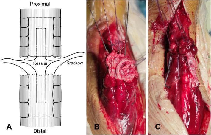 A multi-panel medical resource demonstrating surgical techniques for Achilles tendon repair. (A) Anatomical diagram illustrating the internal logic of a combined Krackow and Kessler suture approach. The Krackow technique shows interlocking peripheral loops, while the modified Kessler technique depicts a central core suture bridging the proximal and distal tendon segments. (B) Intraoperative clinical photograph showing a ruptured Achilles tendon being approximated. The tissue appears erythematous and frayed at the rupture site. Thin, dark non-absorbable sutures are woven through the tendon substance using the Krackow locking loop and modified Kessler techniques to align and stabilize the torn ends. (C) Clinical photograph of the completed repair reinforced with four figure-eight sutures across the dorsal aspect. These sutures create a distinct criss-cross pattern over the rupture site, providing secondary reinforcement to the primary core sutures. This educational material is designed for orthopedic surgery training, focusing on maximizing tensile strength and stability during tendon healing.