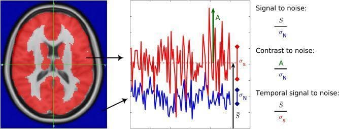 This infographic illustrates functional Magnetic Resonance Imaging (fMRI) quality metrics, combining an axial diagnostic brain image with a signal processing plot. On the left, an axial MRI slice highlights specific regions in red, indicating brain activity areas compared to background tissue. Arrows map these areas to a central time-series plot. The plot features two waveforms: a red signal representing brain activity and a blue signal representing background noise. Key mathematical parameters are annotated: 'S-bar' (horizontal dashed line) represents the mean brain activity signal; 'sigma_S' and 'sigma_N' denote the standard deviations of the brain activity and background noise, respectively; and 'A' (green arrow) indicates the maximum peak amplitude of the brain activity. On the right, three critical quality metric formulas are defined: Signal-to-Noise Ratio (SNR) as S-bar/sigma_N, Contrast-to-Noise Ratio (CNR) as A/sigma_N, and Temporal Signal-to-Noise Ratio (tSNR) as S-bar/sigma_S. This educational diagram is designed for neurology and radiology students to understand the quantitative assessment of signal quality in neuroimaging.