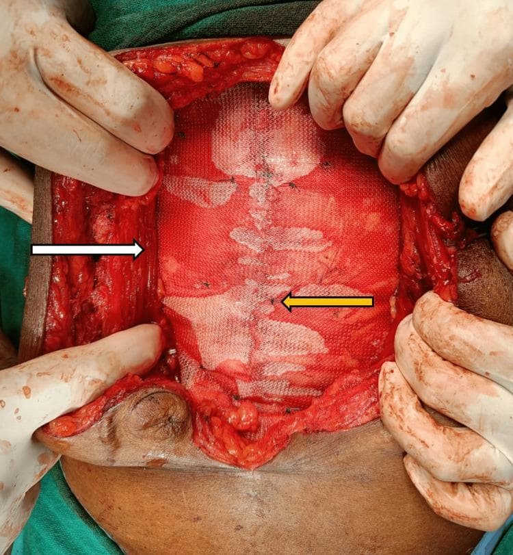 An intraoperative clinical photograph demonstrating the placement of a synthetic mesh during a retrorectus ventral hernia repair (Rives-Stoppa technique). The visual depicts a large, white, microporous polypropylene mesh laid flat in the retrorectus plane. The rectus abdominis muscles are laterally retracted, with a white arrow indicating the medial border of the retracted muscle. The mesh is positioned directly over the posterior rectus sheath, which has been approximated in the midline. A yellow arrow points to interrupted fixation sutures (2-0 Prolene) that secure the mesh to the underlying posterior sheath to prevent migration. The surgical field shows the subcutaneous fat and the margins of the abdominal wall defect. This image serves as an educational example of proper mesh orientation, tension-free placement, and surgical fixation within the submuscular space for complex abdominal wall reconstruction.