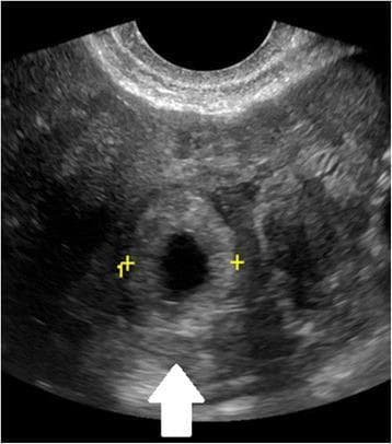 This diagnostic image is a transvaginal ultrasound (TVUS) in the sagittal plane, demonstrating a tubal ectopic pregnancy. The primary finding is the 'bagel sign' or 'tubal ring sign,' which consists of an extrauterine gestational sac—a small, dark, anechoic fluid collection—surrounded by a thick, hyperechoic ring of trophoblastic tissue. This structure is highlighted by a white arrow and yellow calibers (plus signs). The surrounding adnexal tissue and stroma appear heterogeneous in echogenicity. Clinically, this visual finding is highly suggestive of an ectopic gestation located within the Fallopian tube. It is a critical diagnostic marker for medical professionals in evaluating patients presenting with early pregnancy bleeding or abdominal pain when no intrauterine pregnancy (IUP) is identified.