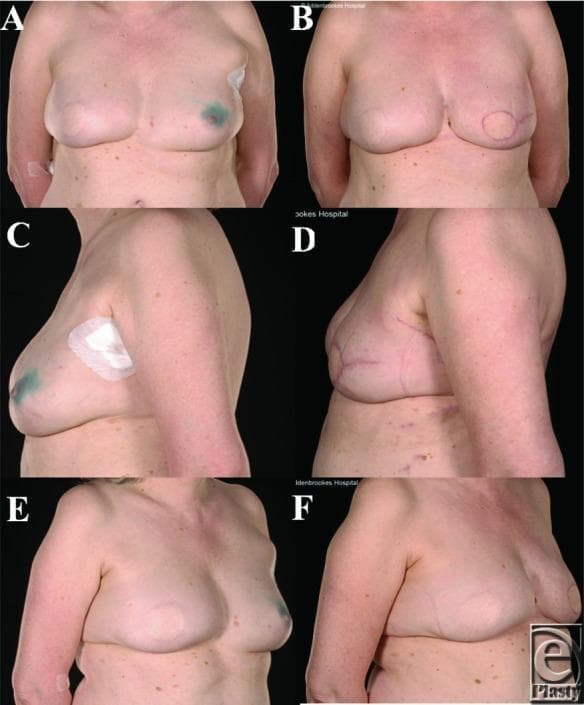 Six-panel clinical photograph displaying preoperative (A, C, E) and postoperative (B, D, F) views of a 54-year-old female patient undergoing left breast Latissimus Dorsi (LD) flap reconstruction. Preoperative views (frontal, left lateral, right oblique) show natural ptosis and surgical markings, including a blueish-green tint (likely patent blue dye for sentinel node localization) near the left nipple and a white adhesive dressing on the left lateral chest. The contralateral right breast shows evidence of a previous TRAM flap reconstruction. Postoperative views (B, D, F) demonstrate the results of a left skin-sparing mastectomy followed by autologous reconstruction. Visible changes include a restored, rounded breast contour with increased volume, improved projection, and reduced ptosis of the left breast. Key surgical features in the postoperative images include circumareolar and horizontal mastectomy scars, and the absence of prior dressings and discoloration. The images illustrate surgical outcomes for breast cancer patients with prior abdominal surgery where TRAM/DIEP flaps are contraindicated, focusing on symmetry and volume matching.