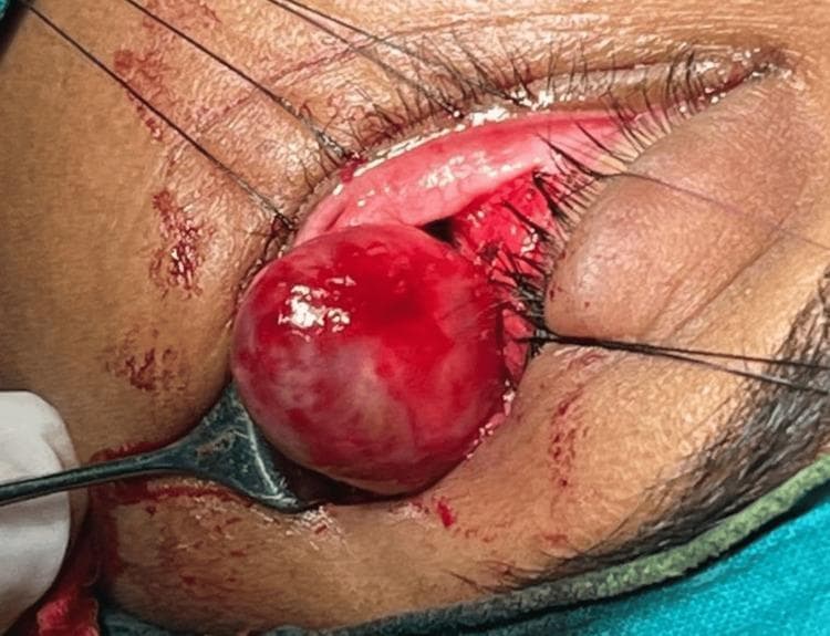 This clinical intraoperative photograph documents a surgical excision of an orbital mass via a lateral orbitotomy approach on the left eye. The image shows a well-defined, spherical, bulbous mass being mobilized from the intraconal compartment. The tumor displays a smooth, encapsulated surface with a reddish-pink, vascular appearance and areas of pale discoloration. Surgical exposure is achieved through an incision at the lateral canthus (lateral canthotomy), with black traction sutures clearly visible holding the eyelid and orbital margins apart to maintain surgical access. A surgical instrument is seen supporting and elevating the mass from the retrobulbar space, displacing surrounding orbital fat and tissues. This procedure is indicated for the management of retrobulbar tumors, such as orbital schwannomas, which often present with axial proptosis. The photograph provides educational insight into orbital surgical anatomy, the presentation of intraconal tumors, and the technique for lateral orbital decompression and tumor delivery.