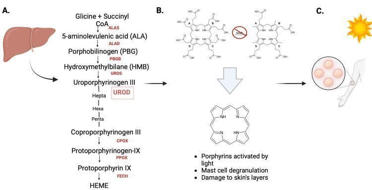 This composite educational infographic illustrates the pathophysiology of Porphyria Cutanea Tarda (PCT) through three integrated sections. Section A depicts the normal heme biosynthesis pathway in the liver, showing the enzymatic conversion starting from Glycine and Succinyl CoA, through intermediates like ALA, PBG, HMB, and Uroporphyrinogen III, catalyzed by enzymes including ALAS, ALAD, and UROD, culminating in HEME production. Section B focuses on the molecular pathogenesis of PCT, highlighting the inhibition of the enzyme Uroporphyrinogen Decarboxylase (UROD). This block leads to the accumulation of porphyrins, which is visually linked to a large chemical structure diagram. Section C demonstrates the clinical manifestation of this metabolic defect. It shows a human arm with a magnified view of cutaneous bullae (blisters) and a sun icon, illustrating how light-activated porphyrins cause mast cell degranulation and oxidative damage to skin layers. The diagram serves as an educational tool for understanding the link between hepatic enzymatic deficiencies and dermatological photosensitivity.