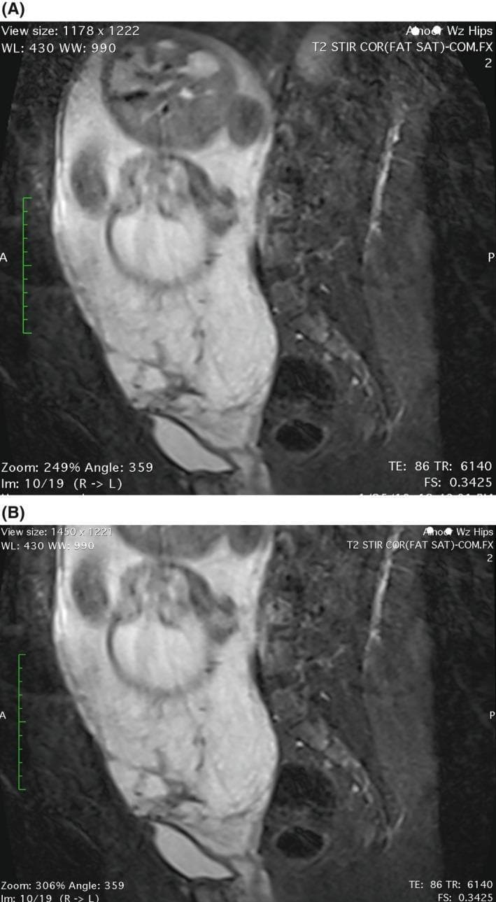 This clinical imaging composite presents two sagittal T2-weighted magnetic resonance imaging (MRI) scans of a pregnant pelvis without contrast, demonstrating placenta previa and signs of invasive placentation. Image (A) highlights significant uterine bulging and the 'tenting sign' of the bladder, where the posterior bladder wall is pulled superiorly and posteriorly toward the lower uterine segment, suggesting abnormal placental adherence or invasion. Image (B) focuses on the lower uterine segment, showing the placenta positioned anteriorly and completely covering the internal cervical os (placenta previa totalis). Key features include the loss of the normal retroplacental T2-hypointense zone and thinning of the myometrium, which are indicative of the placenta accreta spectrum (PAS). These images are pedagogically significant for teaching radiological signs of abnormal placentation, identifying the relationship between placental tissue and the bladder-uterine serosa interface, and evaluating secondary signs of invasive pregnancy complications in obstetric imaging.