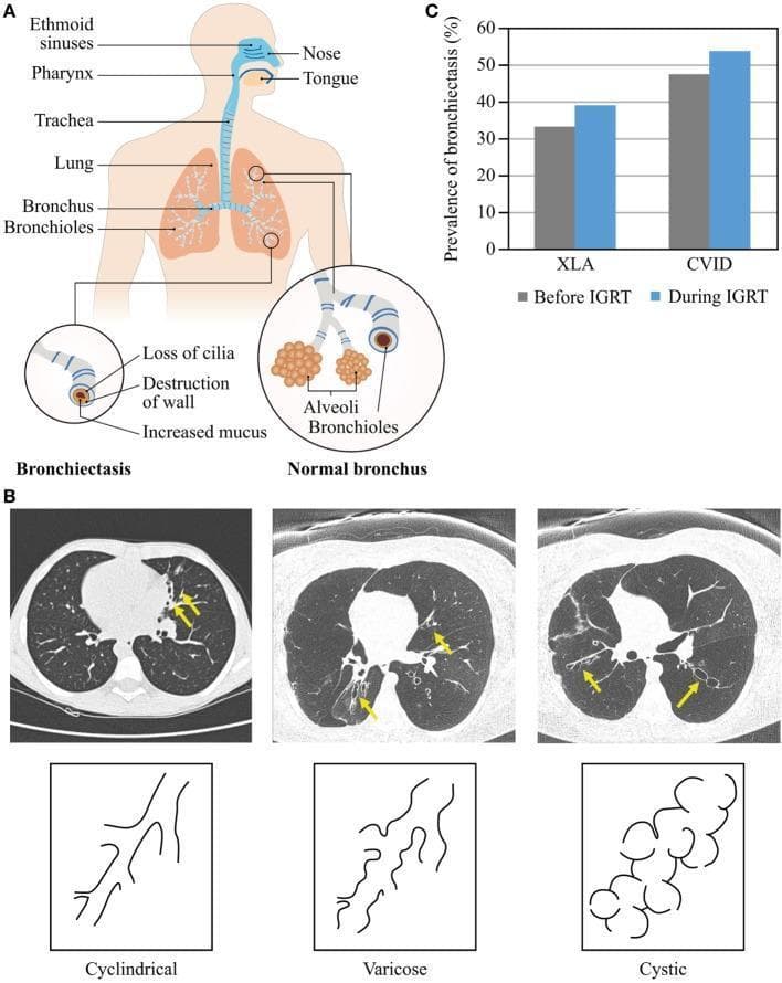 This composite educational image illustrates the pathophysiology and types of bronchiectasis in the context of primary antibody deficiencies. Panel A contains an anatomical diagram showing the respiratory system from the nasal cavity to the bronchioles. It provides a comparative cross-sectional schematic between a normal bronchus and one affected by bronchiectasis, highlighting histopathological changes including loss of cilia, destruction of the bronchial wall, and increased mucus production. Panel B presents three axial High-Resolution Computed Tomography (HRCT) lung windows with corresponding line drawings illustrating the morphological classification of bronchiectasis: Cylindrical (uniform, tubular dilation), Varicose (irregular, beaded appearance with alternating dilation and constriction), and Cystic (sac-like dilations often appearing in clusters). Panel C is a bar graph showing the prevalence of bronchiectasis in patients with X-linked agammaglobulinemia (XLA) and common variable immunodeficiency (CVID) before and during immunoglobulin replacement therapy (IGRT), demonstrating an increase in prevalence with disease duration despite treatment. This resource is intended for medical students and clinicians focusing on pulmonology and immunology.