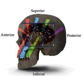 This anatomical diagram illustrates the innervation and myofascial trigger points of the human temporalis muscle overlaid on a lateral view of a skull. The temporal fossa is divided into six anatomical sextants (labeled 1-6) using a blue grid for topographical classification. Scattered colored dots represent the entry points of the deep temporal nerve branches into the muscle belly, with the highest density observed in sextant 2. Four specific myofascial trigger points (1-4) are identified within the muscle, each associated with distinct colored bands (red, blue, green, and purple) that radiate toward the teeth, orbit, and temporal region to represent referred pain patterns according to Travell and Simons. The diagram is oriented with Superior, Inferior, Anterior, and Posterior labels. This visual serves as a clinical guide for understanding the correlation between neuromuscular anatomy and pain management in the craniofacial region, specifically for diagnostic and therapeutic interventions like trigger point injections or nerve blocks.
