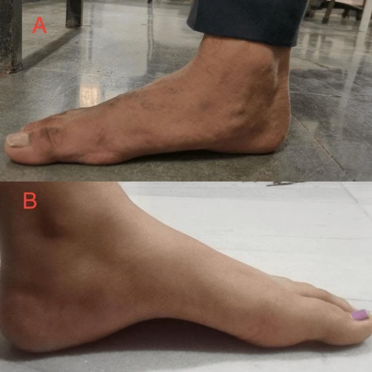 This clinical photograph provides a side-by-side comparison of two distinct foot arch morphologies in a musculoskeletal context. Image A illustrates Pes Planus (flat foot), characterized by a collapsed medial longitudinal arch where the plantar surface of the midfoot makes near-complete contact with the ground. Image B illustrates Pes Cavus (high-arched foot), showing a markedly exaggerated medial longitudinal arch with a significant visible gap between the midfoot and the floor. The comparison demonstrates common orthopedic variations of the foot's structural alignment. These images serve as educational visual aids for identifying common foot deformities associated with gait abnormalities, plantar fascia tension, and muscle imbalances in physiotherapy and orthopedic assessments. The contrast highlights the difference between an absent arch (A) and an abnormally high arch (B), both of which can impact biomechanical stability and result in pain or instability.