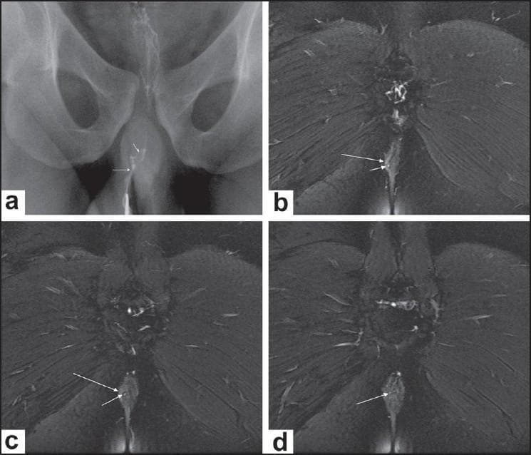 This composite figure illustrates a human intersphincteric perianal fistula using two imaging modalities. Image (a) is a conventional radiographic fistulogram showing a thin, contrast-filled tract near the midline with an internal communication point within the anal canal. Images (b), (c), and (d) are sequential posterior-to-anterior coronal fat-saturated T2-weighted MRI scans. These images demonstrate the anatomy of the anal sphincter complex where the external anal sphincter appears as a hypointense (dark) lateral structure and the internal sphincter/mucosa is relatively hyperintense. A small, high-signal intensity (bright) tract is clearly visible within the intersphincteric plane, located medially to the right external sphincter. The sequence captures the fistula's course as it originates in the intersphincteric space and eventually opens into the anal canal (arrow in d). The fat-saturated MRI technique provides excellent contrast between the fluid-filled inflammatory tract and the surrounding muscular structures and suppressed ischioanal fossa fat, which is essential for accurate surgical planning and classification of perianal fistulous disease.