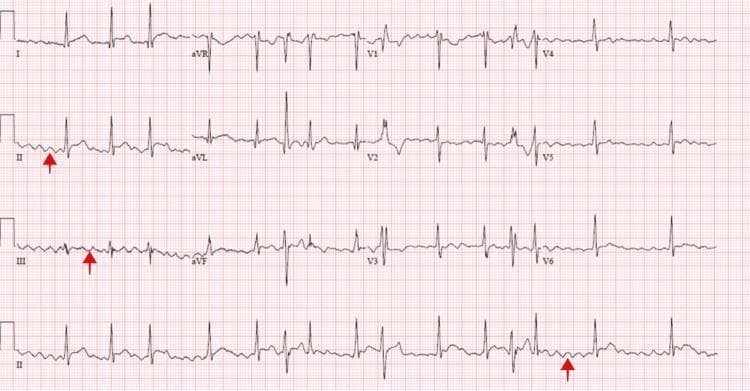 A 12-lead electrocardiogram (ECG) with a rhythm strip at the bottom demonstrating atrial fibrillation and aberrant ventricular conduction. The tracing shows an 'irregularly irregular' rhythm characterized by variable R-R intervals and the absence of organized P waves. Instead, low-amplitude fibrillatory waves are visible along the baseline, specifically highlighted by red arrows in leads II, III, and the continuous rhythm strip. The QRS complexes exhibit polymorphic features, with varying morphologies and widths across different beats, suggesting intermittent intraventricular conduction disturbances or Ashman phenomenon. T-wave morphology is inconsistent, and baseline fluctuations are present. This diagnostic image illustrates the electrical manifestations of atrial arrhythmia commonly associated with clinical scenarios such as hyperthyroidism or cardiac tamponade. The tracing is presented on standard grid paper, facilitating the assessment of heart rate and interval durations for cardiology education and clinical diagnosis.