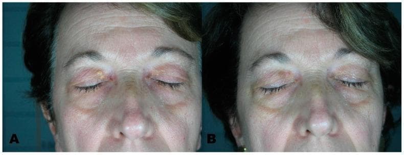 This clinical comparison photograph illustrates the dermatological management of xanthelasma palpebrarum using laser therapy. Panel A displays the 'before treatment' state of an adult patient, showing characteristic yellowish, well-demarcated, slightly raised plaques located on the medial aspect of the upper eyelids bilaterally. The lesions exhibit a soft, velvety texture typical of cholesterol deposits. Panel B displays the 'after treatment' outcome following the use of an Erbium laser. In this post-operative view, the xanthomatous lesions have been successfully ablated. The skin of the periorbital region shows resolution of the yellow plaques with minimal residual erythema or scarring in the treated zones. This comparison serves as an educational example of cosmetic and clinical dermatology, specifically highlighting the efficacy of laser resurfacing for benign periorbital skin lesions and the aesthetic restoration of eyelid skin uniformity.
