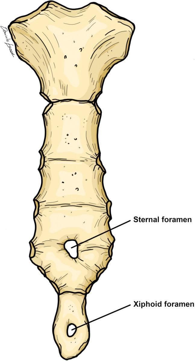 This anatomical diagram illustrates the anterior view of a human sternum, highlighting common congenital variations. The illustration clearly defines the three primary segments: the superior manubrium, the elongated segmented body (gladiolus), and the inferior xiphoid process. Two distinct developmental defects are labeled: a 'Sternal foramen' located in the inferior third of the sternal body and a 'Xiphoid foramen' situated centrally within the xiphoid process. Both foramina are depicted as circular perforations through the bone. These anatomical variants result from the incomplete midline fusion of the cartilaginous sternal bars during embryological development. The image serves as an educational tool for clinical anatomy and radiology, emphasizing the importance of recognizing these benign variants to avoid misinterpretation as pathology (such as lytic lesions) or potential complications during medical procedures like sternal punctures or acupuncture.