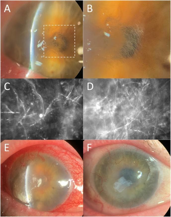 A multi-panel figure illustrating the clinical presentation, diagnostic imaging, and surgical management of a fungal corneal ulcer (Phialophora chinensis keratitis). Panels 1A and 1B (slit lamp photographs) demonstrate a corneal ulcer with surrounding anterior stromal haze, thinning, and characteristic hair-like, filamentous elements visualized on retroillumination. Panels 1C and 1D show in vivo confocal microscopy (IVCM) of the corneal stroma, revealing highly reflective, branching, and interconnected filamentous structures pathognomonic for fungal hyphae. Panel 1E displays clinical progression with worsening conjunctival injection, increased ulcer size, corneal edema, and superficial neovascularization. Panel 1F shows the post-operative appearance following superficial keratectomy and placement of a layered amniotic membrane; visible is the residual membrane graft filling the previously thinned corneal areas. The series highlights the importance of IVCM in diagnosing filamentous fungal keratitis and tracks the disease from initial infection through surgical resolution.