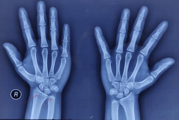 This diagnostic image is an anteroposterior (AP) X-ray radiography of both the right and left hands and wrists. The skeletal assessment focuses on bone age determination and developmental maturity. Visible anatomical structures include the phalanges, metacarpals, carpal bones, and the distal radius and ulna of both limbs. A key clinical finding, highlighted by red arrows on the right wrist, is the complete ossification and fusion of the distal epiphyses of the radius and ulna with their respective metaphyses. There is a total absence of visible radiolucent lines representing open physes (growth plates) across all long bones of the hands and wrists, including the metacarpals and phalanges. This visual state signifies advanced skeletal maturity, corresponding to a bone age of approximately 17 years or older. This imaging is commonly used in pediatric endocrinology to evaluate discrepancies between chronological age and skeletal development in conditions such as congenital adrenal hyperplasia or precocious puberty.