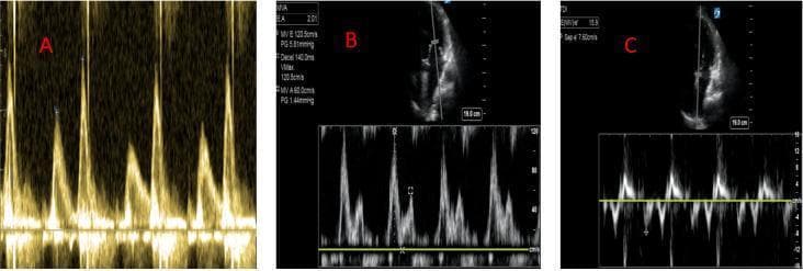 This diagnostic composite displays three panels (A, B, and C) of Doppler echocardiography findings used to assess left ventricular diastolic function. Panel A shows a pulsed-wave Doppler trace of mitral inflow with an inverted E/A ratio (E < A), characteristic of Grade 1 diastolic dysfunction (impaired relaxation). Panel B illustrates Grade 3 diastolic dysfunction (restrictive filling pattern) with a tall, narrow E wave and a markedly diminished A wave, resulting in an E/A ratio > 2.0. Panel C demonstrates tissue Doppler imaging (TDI) used to calculate the E/e' ratio. The spectral waveform shows a high-velocity E wave relative to a low-velocity e' (septal) wave, with an E/e' ratio > 15, which is clinically indicative of elevated left ventricular end-diastolic pressure (LVEDP). The grayscale inserts in B and C show the anatomical positioning of the sample volume within the four-chamber view of the heart. Key hemodynamic parameters displayed include peak velocities (Vmax), pressure gradients (PG), and deceleration time (Decel), which are essential for categorizing the severity of heart failure with preserved ejection fraction (HFpEF).