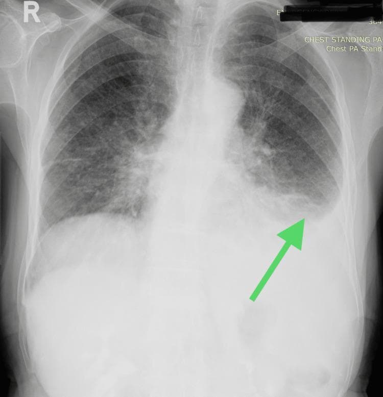 A posterior-anterior (PA) chest X-ray demonstrating a left-sided pleural effusion. The primary finding, indicated by a green arrow, is an area of increased homogenous radiopacity in the lower left lung field. This opacity causes blunting of the left costophrenic angle and exhibits a characteristic meniscus signβa curved upper border that tracks superiorly along the lateral chest wall. In contrast, the right lung field appears clear with a sharp costophrenic angle and visible vascular markings. The mediastinal shadow is central, and the visualized bony structures, including the ribs and clavicles, are shown. In the clinical context of multiple myeloma, this exudative effusion and the subtle lucencies in the visualized humerus and scapula are significant for systemic disease involvement. This diagnostic image is intended for medical students and clinicians to illustrate radiographic signs of pleural fluid accumulation and associated musculoskeletal complications in plasma cell dyscrasias.