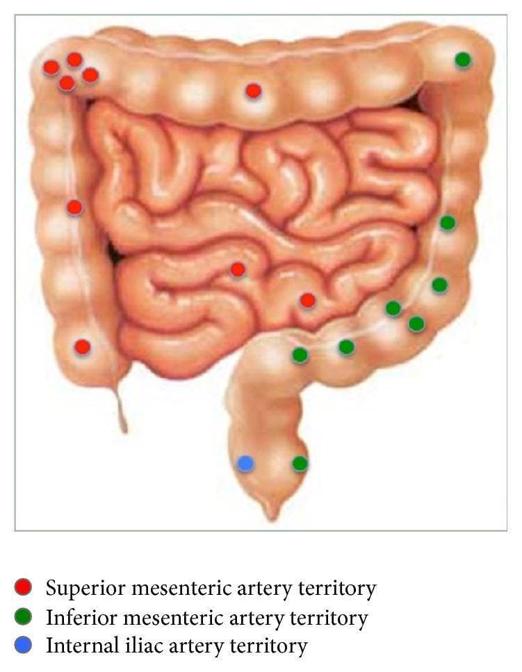 An anatomical diagram illustrating the distribution of gastrointestinal bleeding sites categorized by vascular territories. The diagram shows the large intestine (segmented haustra) and the small intestine (coiled loops) with superimposed colored markers. Red dots represent the superior mesenteric artery (SMA) territory, primarily involving the small intestine, cecum, ascending colon, and the proximal two-thirds of the transverse colon. Green dots indicate the inferior mesenteric artery (IMA) territory, covering the distal transverse colon, descending colon, and sigmoid colon. A single blue dot marks the internal iliac artery territory at the level of the rectum. The educational focus is on correlating anatomical bleeding locations with their respective arterial supply, which is critical for planning diagnostic interventions like angiography or embolization in cases of lower gastrointestinal hemorrhage. Key concepts include mesenteric vascular anatomy and clinical localization of bowel pathology.