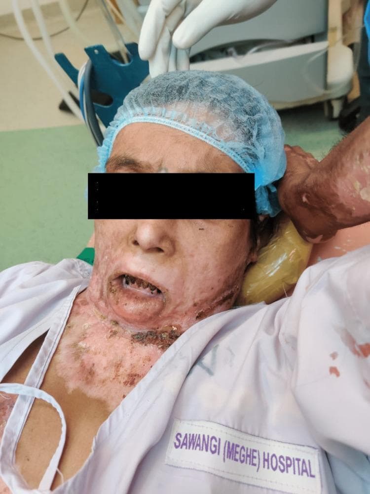Clinical photograph of a patient in a supine position, demonstrating severe post-burn sequelae affecting the lower face, neck, and upper chest. Key clinical findings include extensive hypertrophic scarring and contracture bands extending from the submental region to the infraclavicular area. The neck contracture has resulted in a fixed flexion deformity at the atlanto-occipital joint, severely restricting cervical extension. Facial involvement is marked by microstomia (restricted mouth opening) and eversion of the lower lip (ectropion) with exposed mucosa. The skin exhibits multi-chromatic dyspigmentation, including areas of hypopigmentation, erythema, and hyperpigmented scarring, along with possible crusting or eschar near the base of the neck. The patient is shown in a perioperative or critical care setting, indicated by the surgical cap, head support, and gloved medical personnel, likely preparing for airway management or reconstructive surgery. This image serves as a significant clinical example of complex burn contractures and the associated challenges in managing difficult airways and physical rehabilitation.