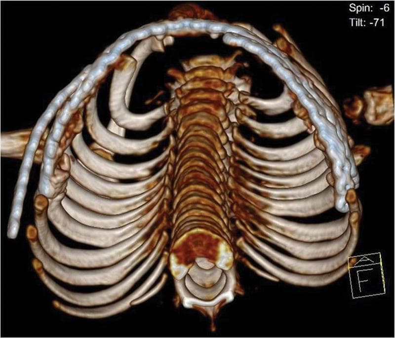This diagnostic image is a 3D reconstructed CT scan of a pediatric thorax, shown in an axial/oblique superior view. The reconstruction highlights the skeletal anatomy of the thoracic cage, including the ribs, thoracic vertebrae, and sternum. A key clinical feature is the presence of surgical hardware: a long, contoured metallic locking plate is positioned along the anterolateral aspect of the rib cage. The plate is shaped to follow the physiological curvature of the chest wall, bridging multiple ribs to provide structural stability and restore thoracic volume. This intervention is characteristic of surgical management for Thoracic Insufficiency Syndrome (TIS) associated with restrictive chest wall deformities like Jeune syndrome (asphyxiating thoracic dystrophy). The image demonstrates the restoration of the anterolateral contour following rib resection and expansion thoracoplasty, aimed at increasing pulmonary capacity. Distinctive features include the visualization of the vertebral column and the symmetrical alignment of the ribs secured by the crown-shaped internal fixation device.