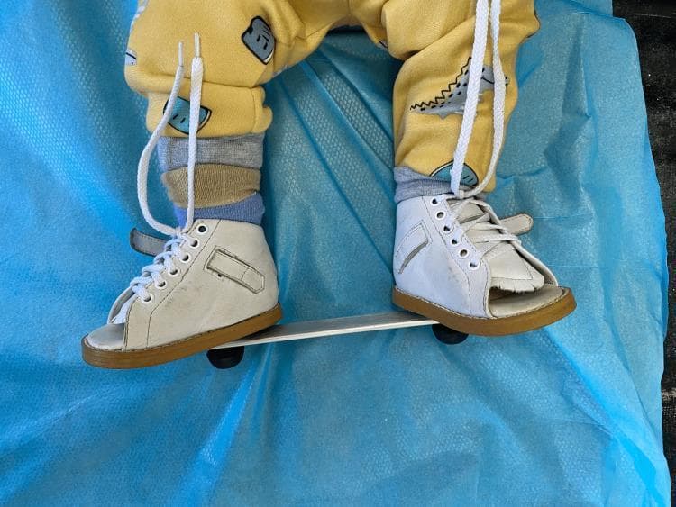 This clinical photograph shows a pediatric patient wearing a standard foot abduction brace, commonly known as a Denis Browne bar. The device is used in the orthopedic management of Congenital Talipes Equinovarus (CTEV), typically following the serial casting phase of the Ponseti method. The brace consists of two white, high-top, open-toe leather shoes with brown rubber soles and white laces, attached to a rigid, adjustable metallic horizontal bar (likely aluminum). The shoes are positioned on the bar to maintain the feet in a specific degree of abduction and external rotation to prevent relapse of the clubfoot deformity. The patient is shown from the waist down, wearing a yellow patterned sweatshirt and multiple layers of socks, positioned on a light blue clinical drape. This visual serves as a medical education example of postoperative or post-corrective maintenance therapy in pediatric orthopedics, highlighting the mechanical components required for maintaining corrected foot alignment.