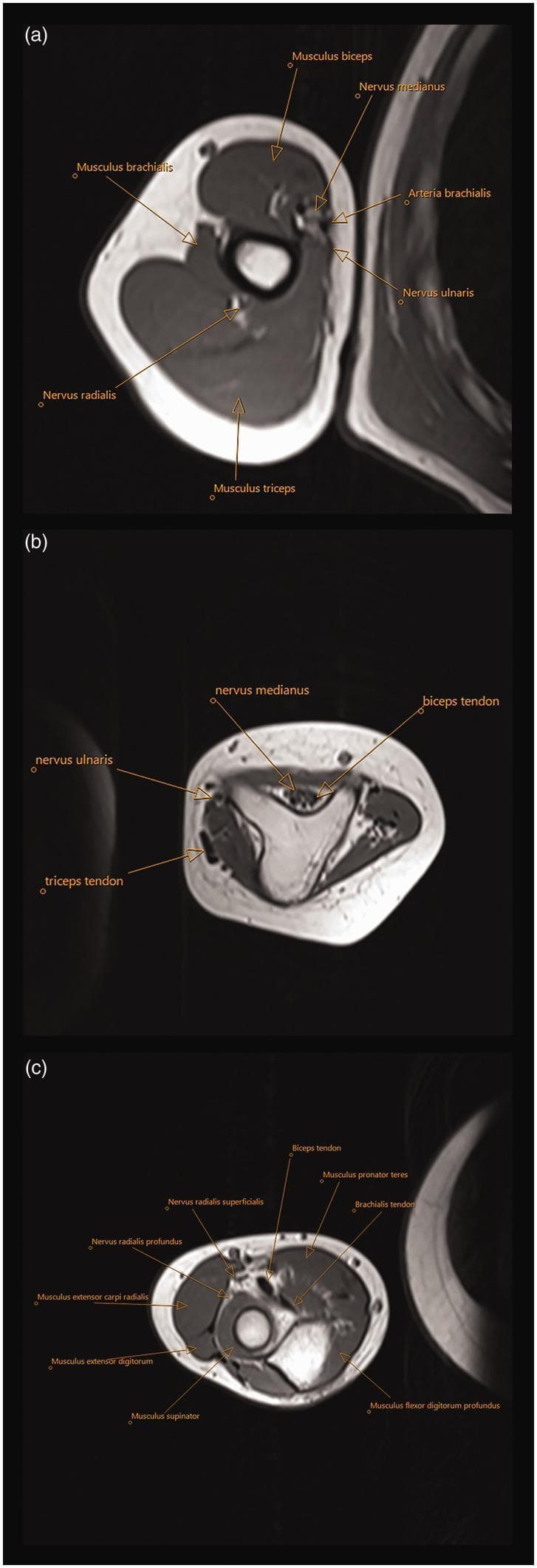 This diagnostic visual contains three labeled axial MRI T1-weighted sections (a, b, c) of the upper extremity, focusing on the musculoskeletal and neurovascular anatomy associated with ulnar dimelia (mirror hand). Section (a) shows the mid-upper arm, identifying the Musculus biceps, Musculus brachialis, and Musculus triceps, alongside the Nervus medianus, Nervus ulnaris, Arteria brachialis, and Nervus radialis in their relative anatomical compartments. Section (b) demonstrates a triangular-shaped dysplastic distal humerus, highlighting the atypical morphology of the bony structures and the positioning of the median and ulnar nerves relative to the biceps and triceps tendons. Section (c) represents a cross-section just distal to the elbow joint, showing two proximal ulnae instead of the standard radius and ulna. It labels the superficial and profound branches of the radial nerve, the biceps and brachialis tendons, and the surrounding musculature including the Musculus pronator teres, Musculus extensor carpi radialis, Musculus extensor digitorum, Musculus supinator, and Musculus flexor digitorum profundus. This series illustrates the complex neurovascular and muscular rearrangements required for surgical planning in congenital limb anomalies.